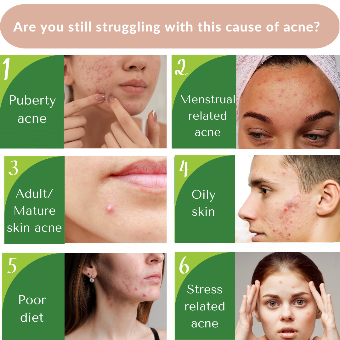 Get rid of Acne problems like cystic acne, puberty acne, period pimples, and stress acne