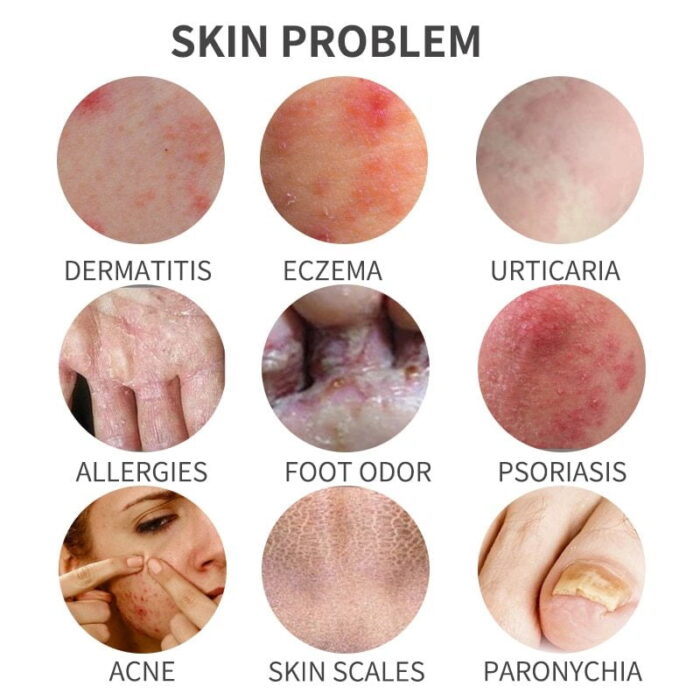 Skin problems treated with Skin Inflammation Relief Cream for Psoriasis, Eczema, and Dermatitis