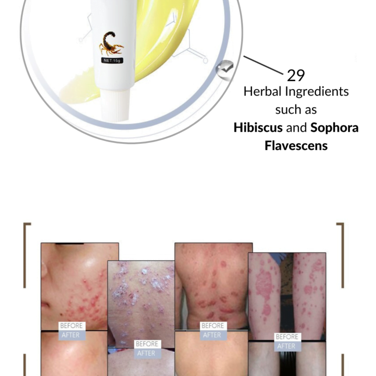 Skin Inflammation Relief Cream for Psoriasis, Eczema, and Dermatitis- before and after