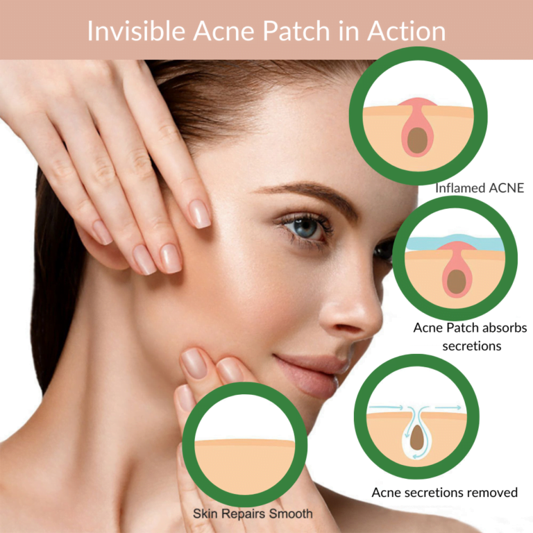 invisible acne patch and how it works for acne with pus, stress acne, cheek acne, cystic acne