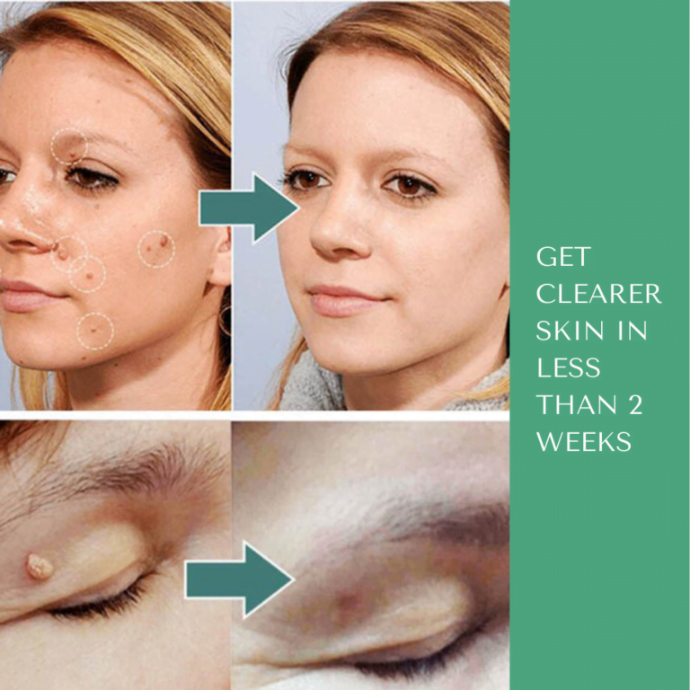 remove skin tags and warts from the face in 2 weeks