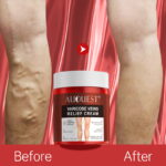 varicose and spider veins removal cream- before and after