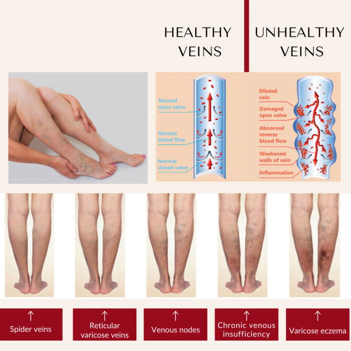varicose and spider veins removal cream - 5 types of veins issues